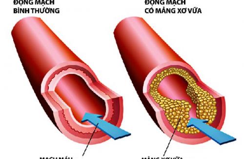 Chặn đứng rối loạn mỡ máu không phải ai cũng biết