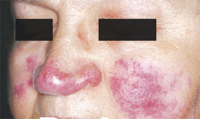 Những biến chứng nguy hiểm bạn cần biết từ lupus ban đỏ
