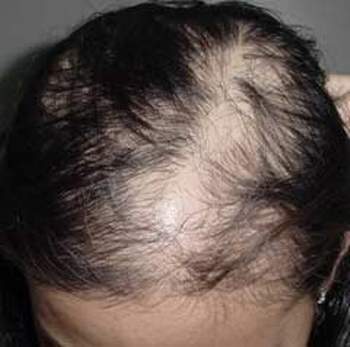 Rụng tóc do thuốc - tham khảo để dùng thuốc hiệu quả, an toàn