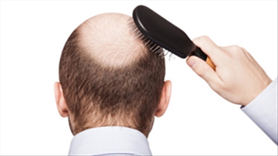 Rụng tóc từng mảng, bạn có biết nguyên nhân do đâu gây ra không?