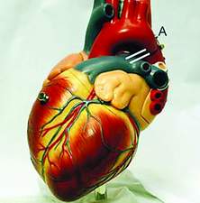 Hướng dẫn dùng thuốc điều trị thấp tim an toàn, hiệu quả