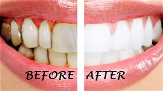 Mách nhỏ 10 cách làm trắng răng tự nhiên rất hiệu quả