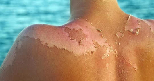 Điểm mặt triệu chứng bệnh thường gặp mùa hè: Số 8 rất dễ phát triển thành ung thư da