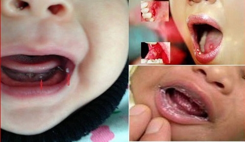 Dấu hiệu nhận biết và điều trị nấm miệng không thể không biết