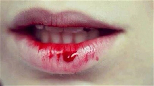 Nguy hại khi bị chảy máu bất thường bạn nên đề phòng