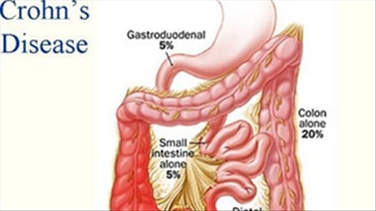 Thuốc lá và nguy cơ mắc bệnh Crohn - Các bạn tham khảo thêm về nó nhé!