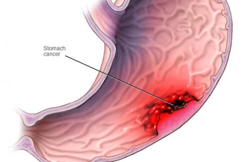 Nguy cơ, triệu chứng và các giai đoạn của ung thư dạ dày