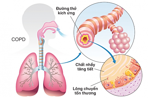 Dịch nhầy đường hô hấp - Nguyên nhân và cách xử lý bệnh