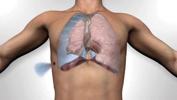 Biến chứng do tràn khí màng phổi, bạn nên biết để phòng tránh