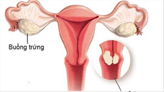 Bảo vệ buồng trứng trong điều trị ung thư cổ tử cung