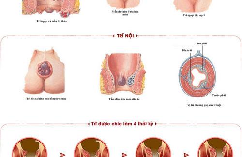 Bệnh trĩ ở phụ nữ mang thai và sau sinh - Các bạn hãy tham khảo thêm về nó nhé!