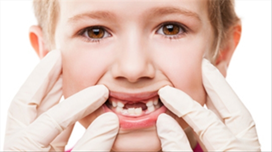 Các mẹ có biết chăm sóc thế nào khi trẻ bị sún răng thế nào không?