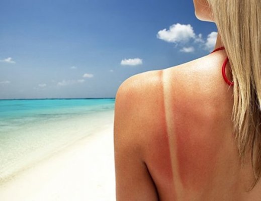 Tổn thương da do nắng và cách hồi phục hiệu quả nhất