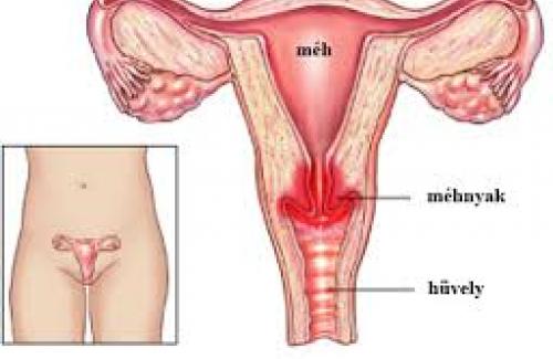 5 dấu hiệu ung thư nội mạc tử cung ai cũng nên biết