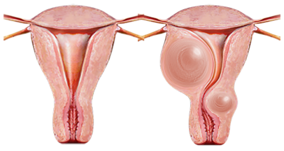 Bài thuốc tiêu u bí truyền: Điều trị hiệu quả u xơ tuyến vú, u xơ cổ tử cung