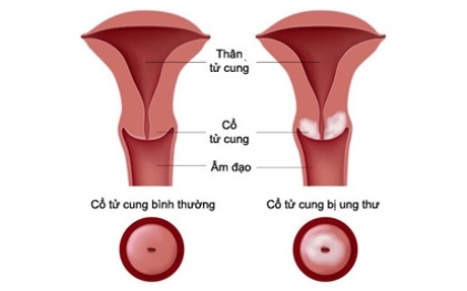 Cách kiểm tra ung thư cổ tử cung, có thể bạn chưa biết