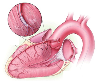 Để hạn chế bệnh tim do tăng huyết áp cần làm những biện pháp sau