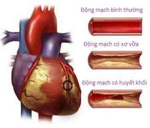 Hút thuốc gây nguy cơ tăng huyết áp và bệnh lý tim mạch như thế nào?