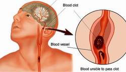 Những loại thuốc phục hồi liệt cơ sau tai biến mạch máu não