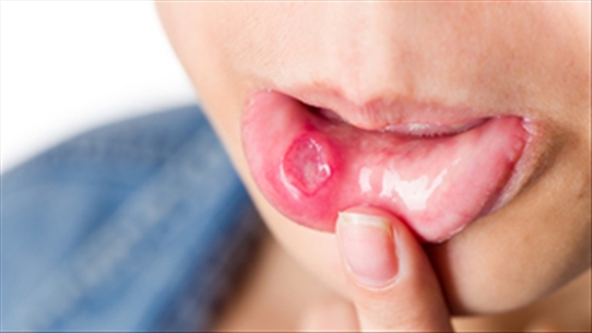Mách nhỏ 10 bài thuốc dân gian giúp bạn trị viêm loét miệng hiệu quả