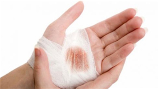Làm thế nào để trị nhiễm trùng gan bàn tay hiệu quả?