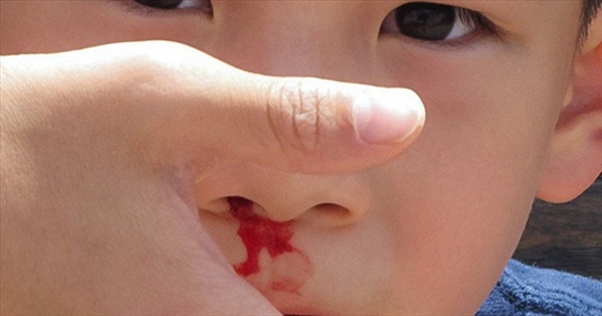 Cảnh báo: Trẻ bị chảy máu cam có thể nguy hiểm tính mạng nếu cứ ngửa đầu ra sau