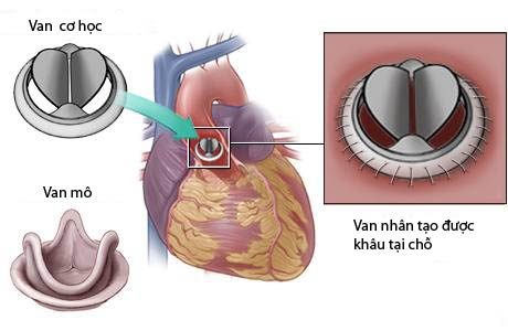 Bệnh van tim, khi nào cần điều trị, có thể bạn chưa biết