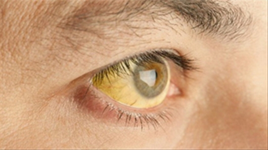 Mắt mà có 4 biểu hiện này thì hãy xem ngay tình trạng sức khỏe