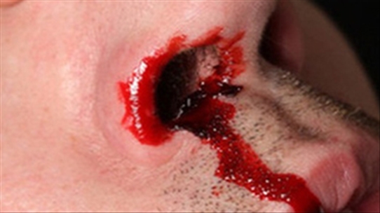 Bệnh nguy hiểm tiềm ẩn khi chảy máu bất thường không thể chủ quan