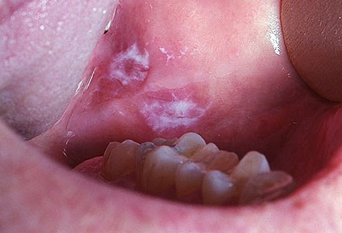 Bệnh răng miệng do thuốc lá gây ra có thể bạn chưa biết