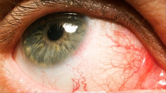Những dấu hiệu ở mắt giúp bạn nhận biết bệnh nhanh nhất