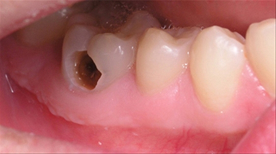 Răng hàm bị sâu thì có nên "tự xử" ở nhà hay không?