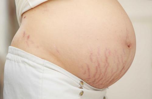 Mách mẹ bầu một số cách hay chống rạn da khi mang thai