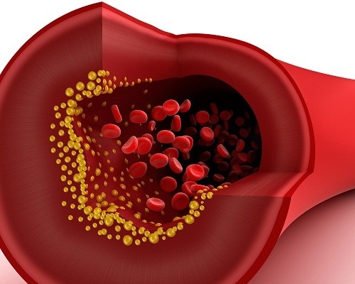 Các phương pháp giúp ngăn ngừa và trị rối loạn lipid máu