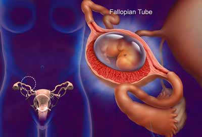 Mách nhỏ những dấu hiệu điển hình khi chửa ngoài tử cung