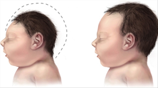 Nhận biết trẻ sơ sinh bị tật đầu nhỏ qua số chu vi vòng đầu