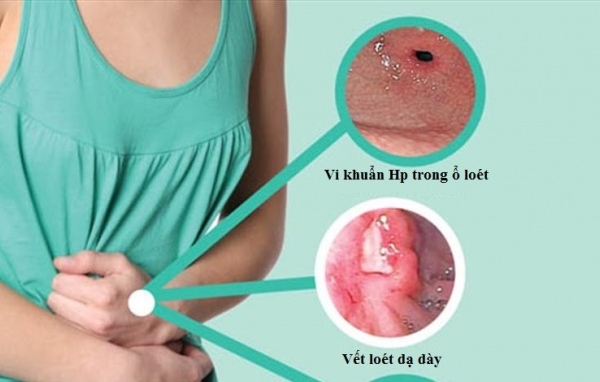 70% người Việt mắc vi khuẩn có thể gây ung thư dạ dày - Phòng bệnh cách nào?