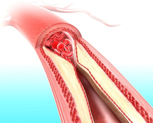 Tích tụ calci trong động mạch chỉ báo nguy cơ đau tim bạn có biết?