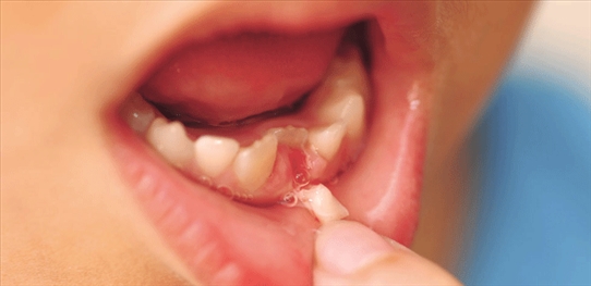 Hậu quả khi mất răng sữa sớm là gì? Cùng tìm hiểu nhé!