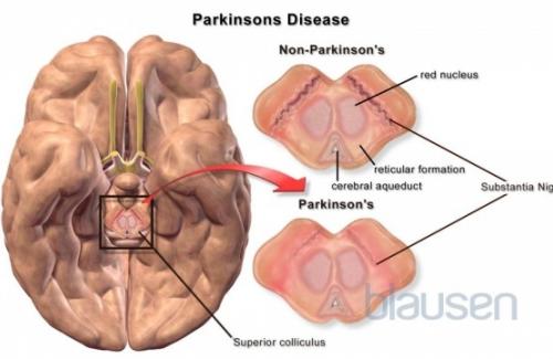 Parkinson, bệnh của người cao tuổi, làm sao để phòng tránh?
