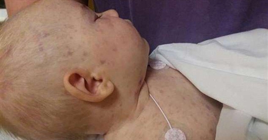 Cảnh báo: Bé 4 tháng tuổi bị tử vong do bị viêm màng não do tiếp xúc với người chưa đươc tiêm chủng