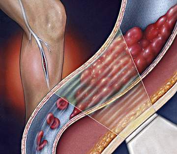 Bệnh mạch máu ngoại biên - chẩn đoán và cách điều trị bệnh