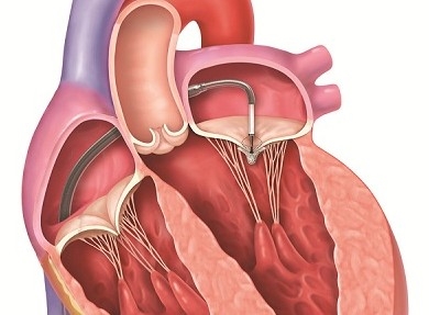 Phương pháp hay điều trị hở van tim hai lá không cần phẫu thuật