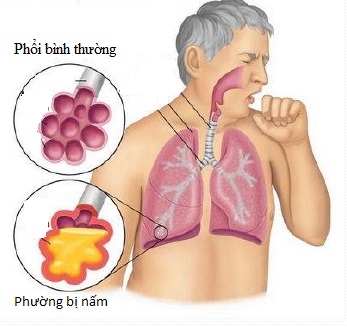 Nấm phổi: Bệnh thường gặp nhưng mọi người rất dễ bỏ qua