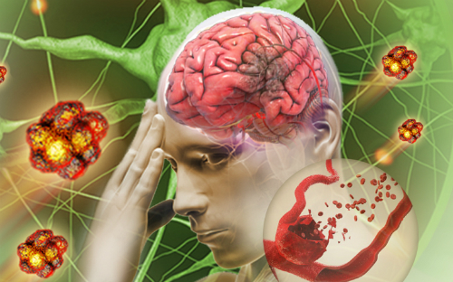 Kiểm soát đau đầu giúp dự phòng nguy cơ đột quỵ cho bạn