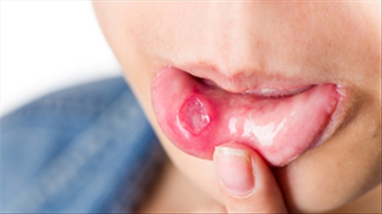 Viêm loét miệng - Bệnh gây nhầm lẫn nhiều người mắc phải