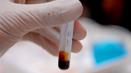 BS Nguyễn Thị Hòa: Chỉ số xét nghiệm máu cho thấy dấu hiệu viêm nhiễm