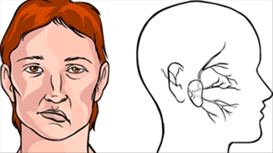 Bệnh méo miệng có phải là dấu hiệu tổn thương não không?