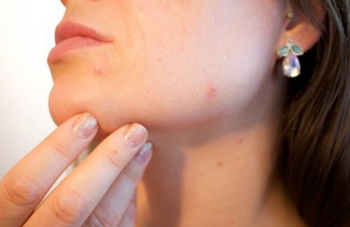 Những bệnh về da thường gặp  mà bạn cần lưu ý để chăm sóc da khỏe