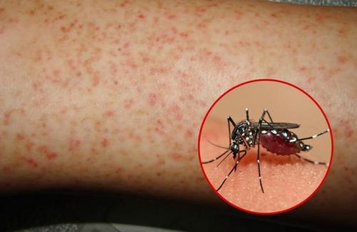 Làm sao để ngăn chặn biến chứng nguy hiểm của sốt xuất huyết ở trẻ?